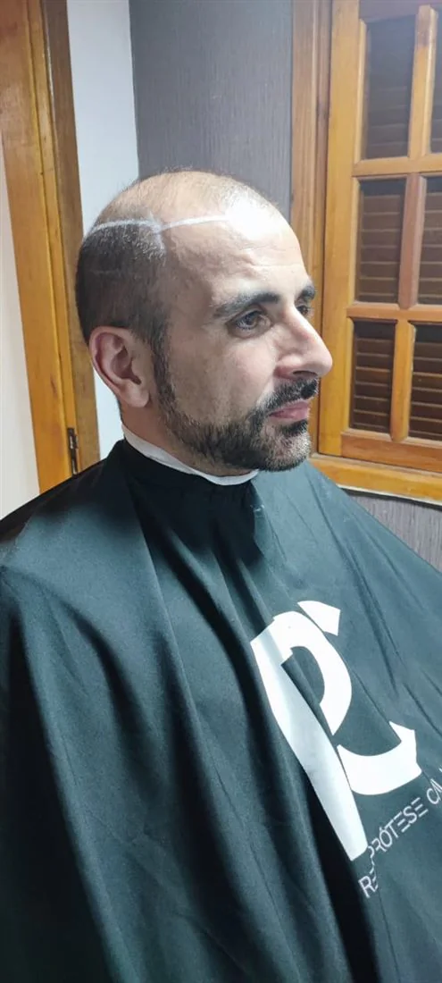 Linha frontal antes da aplicação de prótese capilar